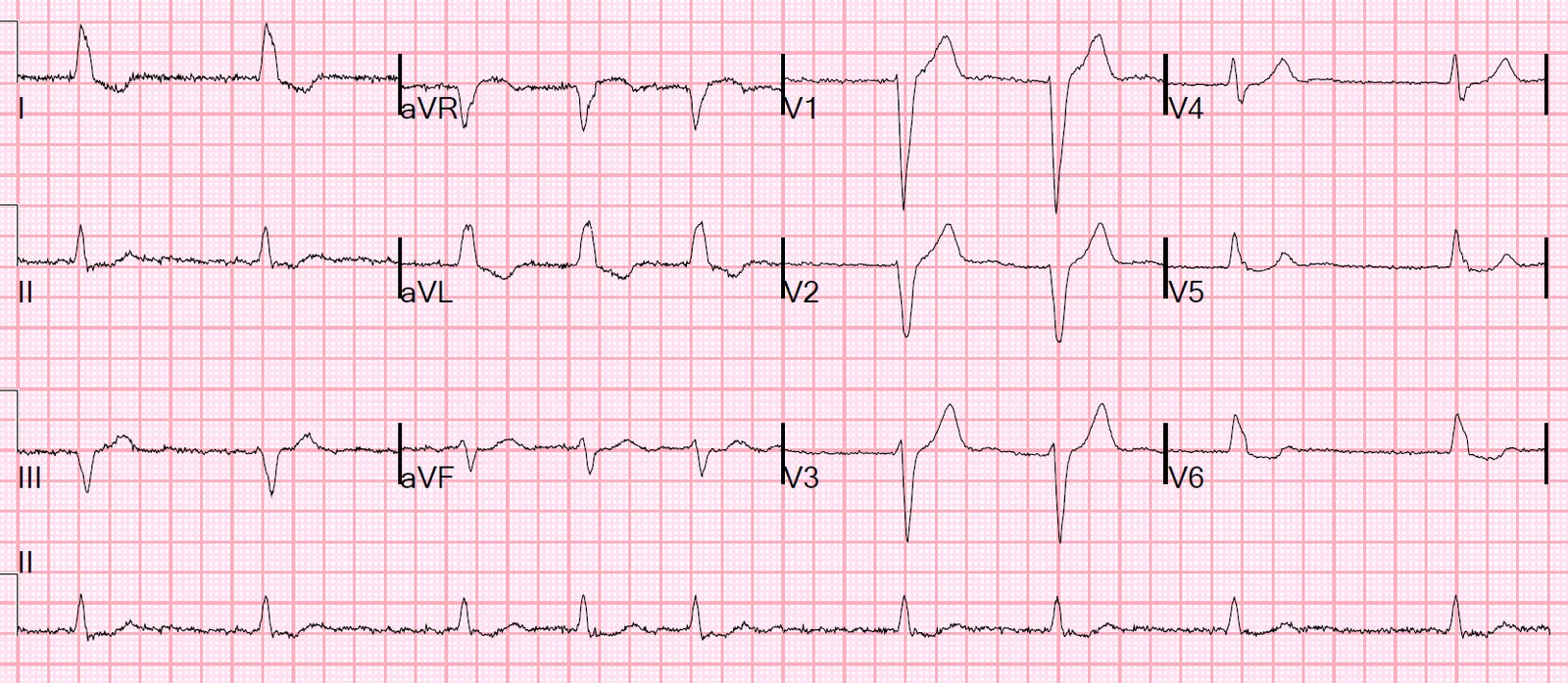 Case of Atrial fibrillation with slow ventricular response