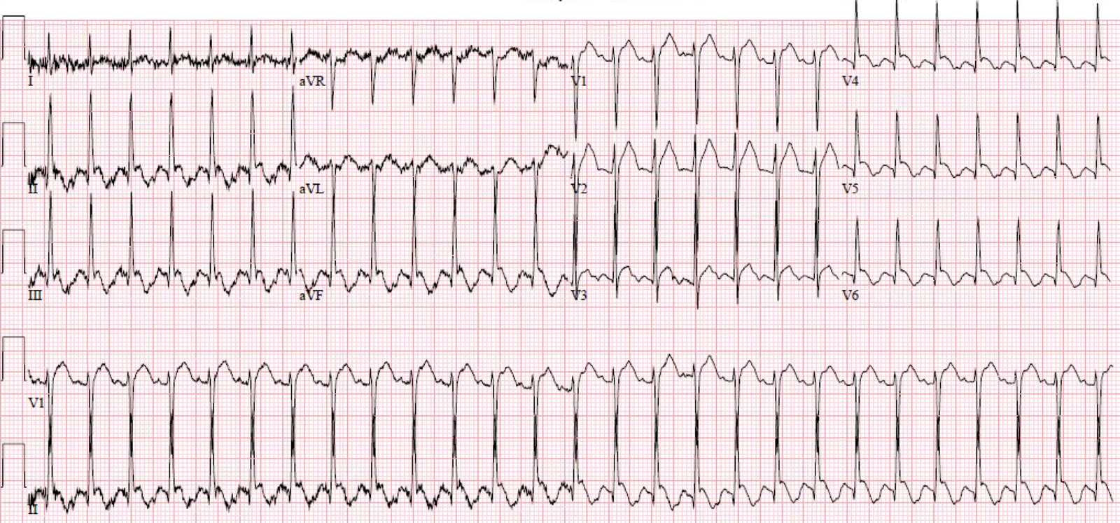 Case of Atrial flutter with 2:1 AV conduction