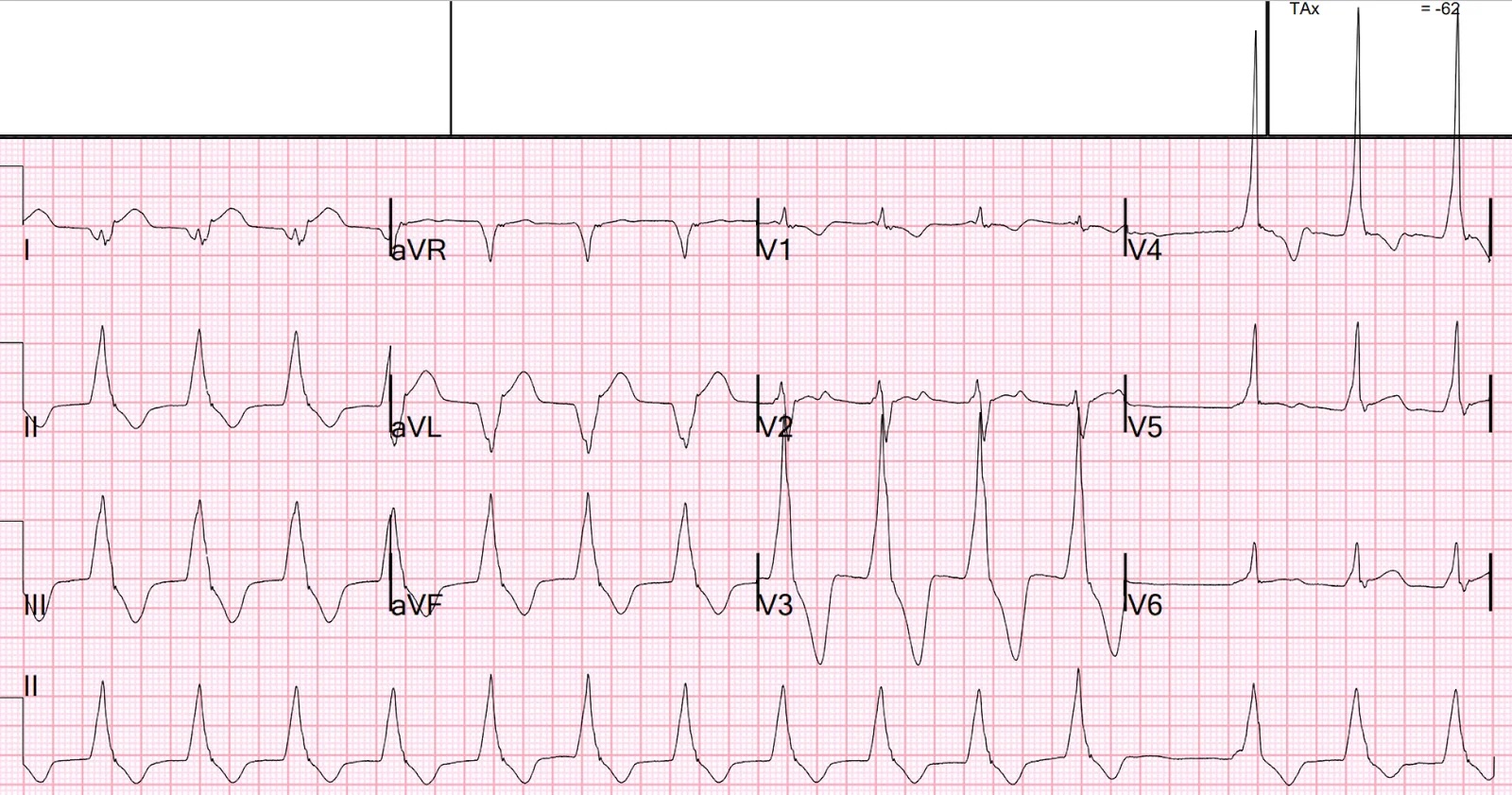 Case of Accelerated idioventricular rhythm
