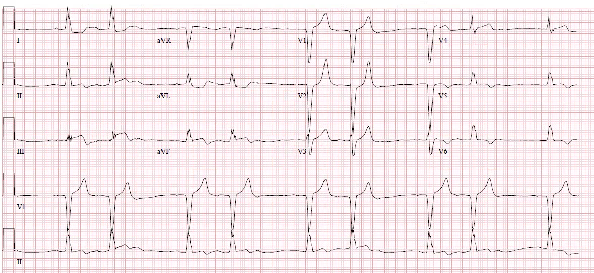 Case of second-degree AV block caused by inferior STEMI
