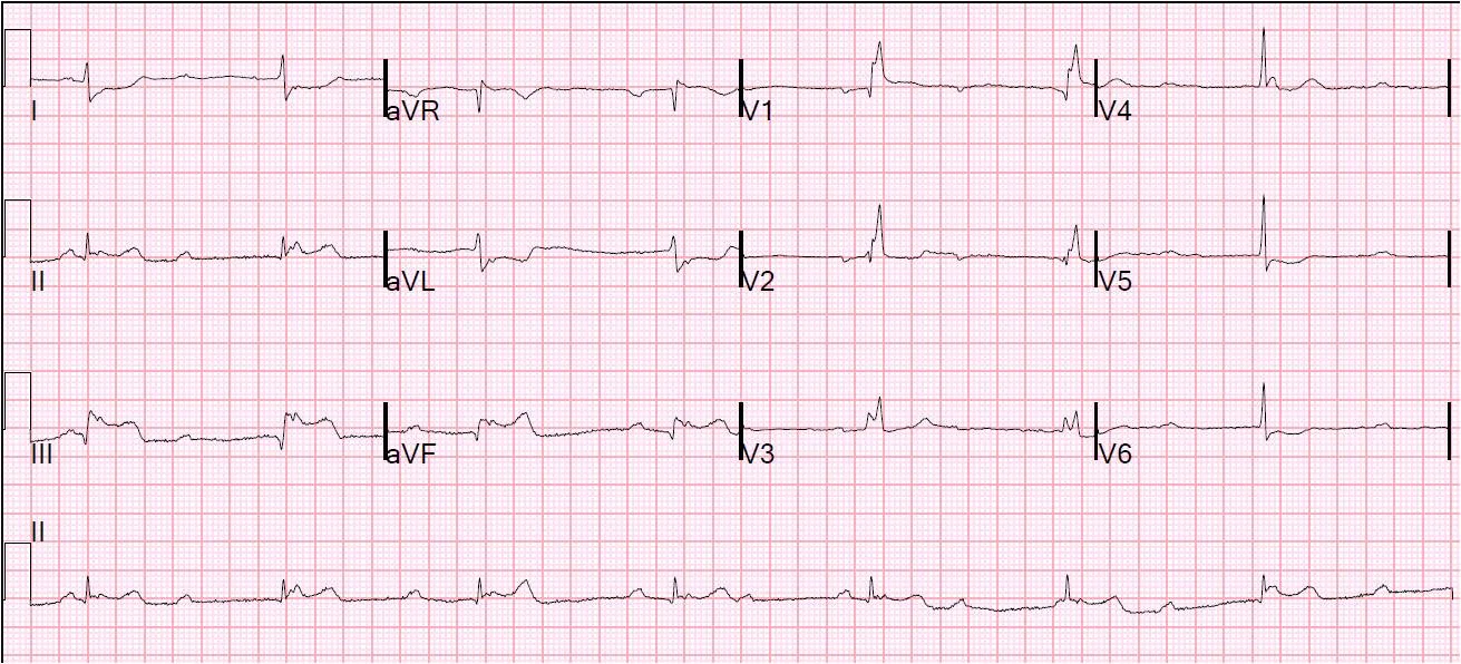 Case of third-degree AV block with junctional escape rhythm