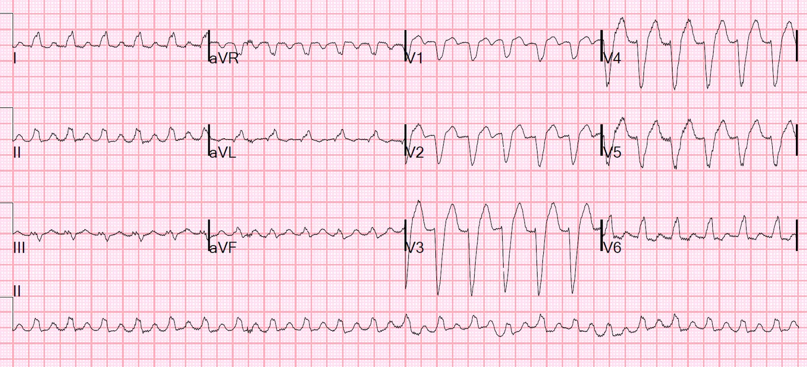 Case of Paroxysmal supraventricular tachycardia with aberrancy