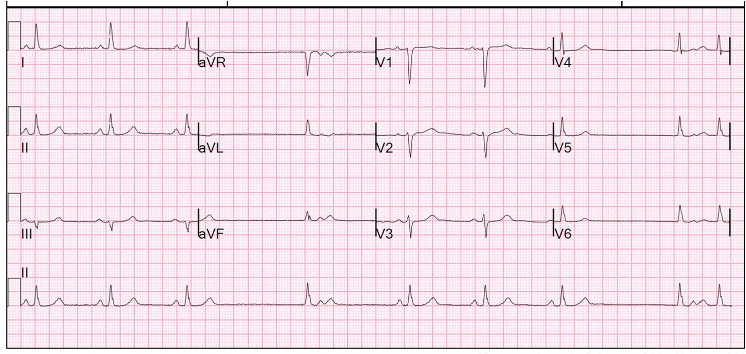 Case of second-degree Sinoatrial exit block