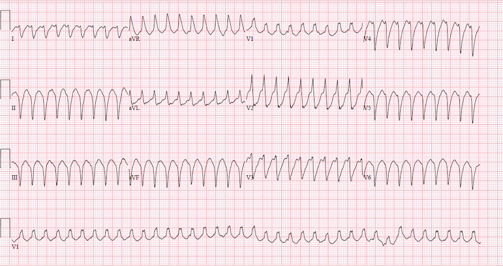Case of Ventricular tachycardia