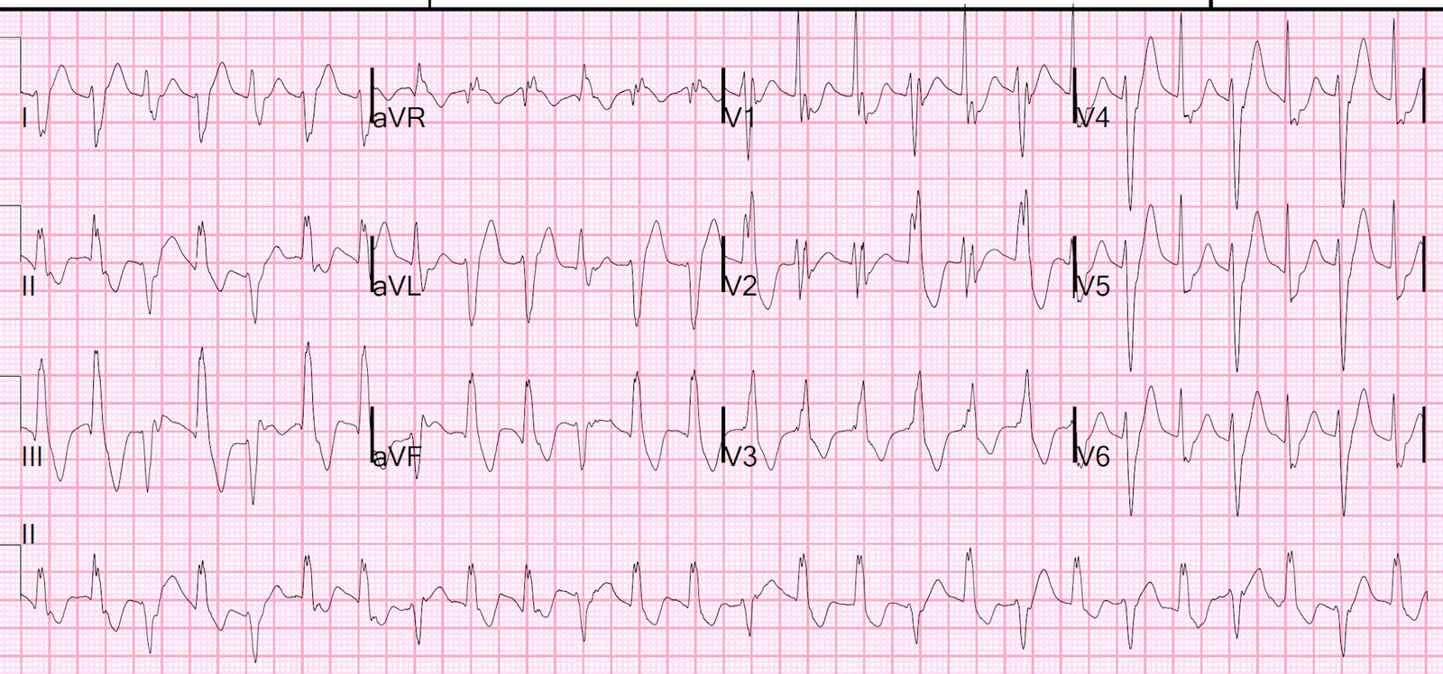 Case of bidirectional Ventricular tachycardia