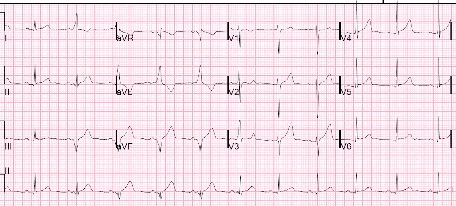 Case of WPW syndrome