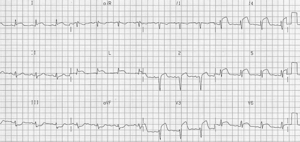 Case of anterior STEMI