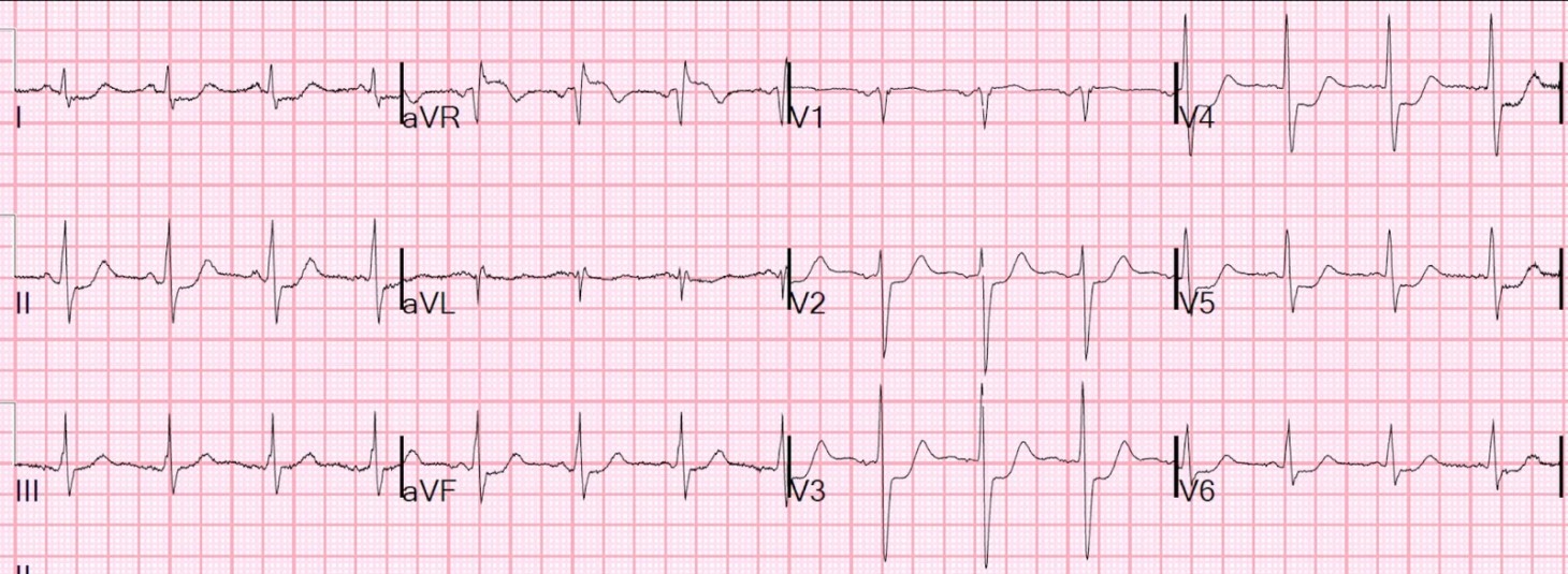 Case of ST elevation in aVR