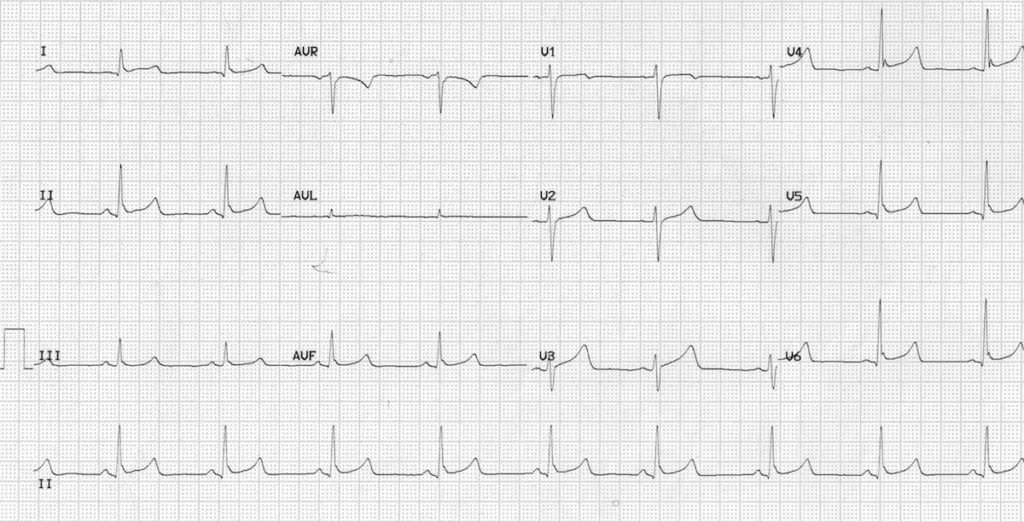Case of early repolarization