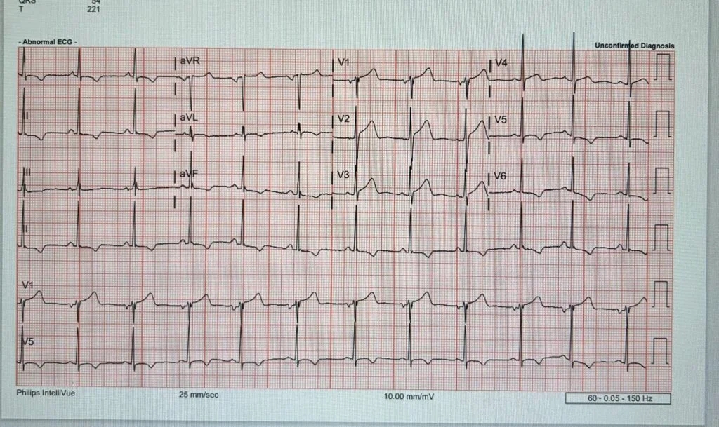 Case of left ventricular hypertrophy