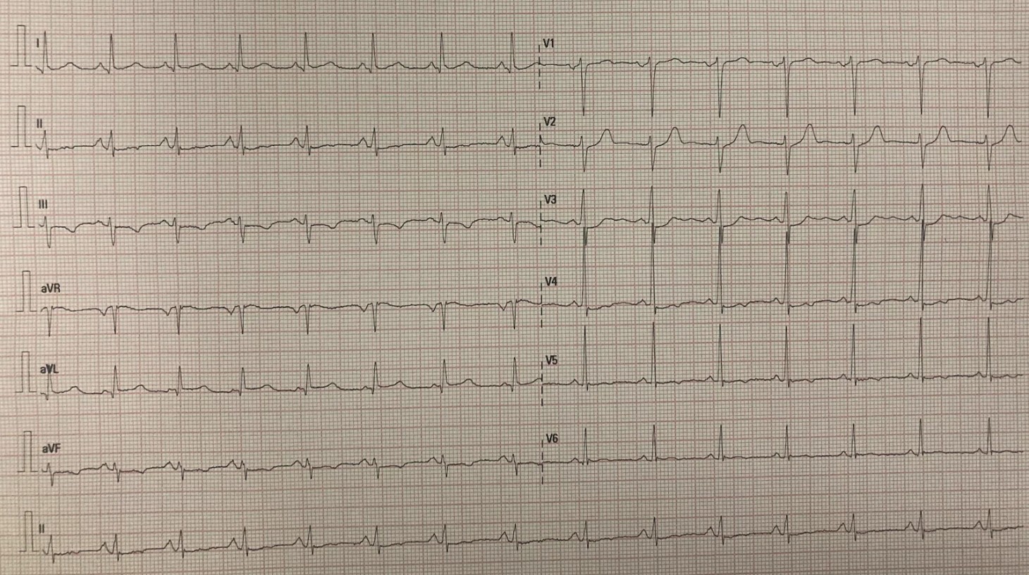 Case of posterior MI
